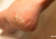 Cara Mengatasi Tumit Pecah dengan Bahan Herbal