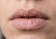 tips mengatasi bibir kering