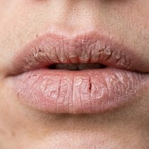 tips mengatasi bibir kering