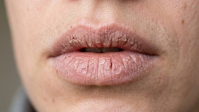 tips mengatasi bibir kering